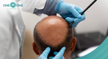 Best Hair Transplant Clinic in Egypt